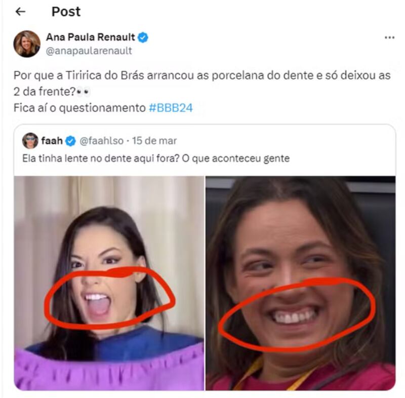 Beatriz do BBB 24 retirou lentes dos dentes para entrar no reality?