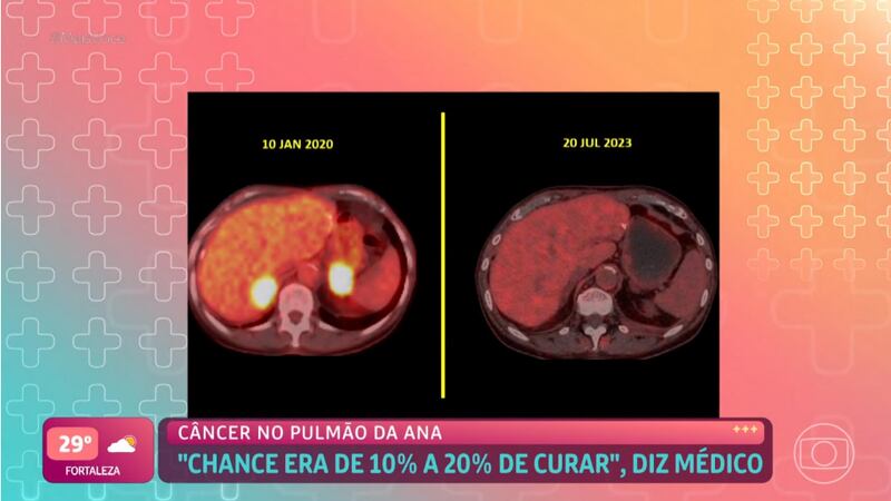 O oncologista que tratou Ana Maria Braga revelou que ela tinha apenas de 10 a 20% de chances de cura