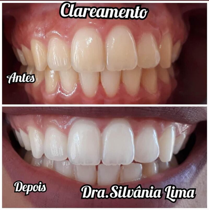 Antes e depois de um clareamento dental