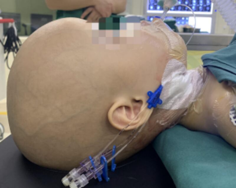 Feto é encontrado em crânio de bebê de um ano, que não sobreviveu à cirurgia de retirada