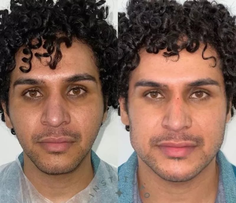 Antes e depois de Charles Teixeira, de 30 anos