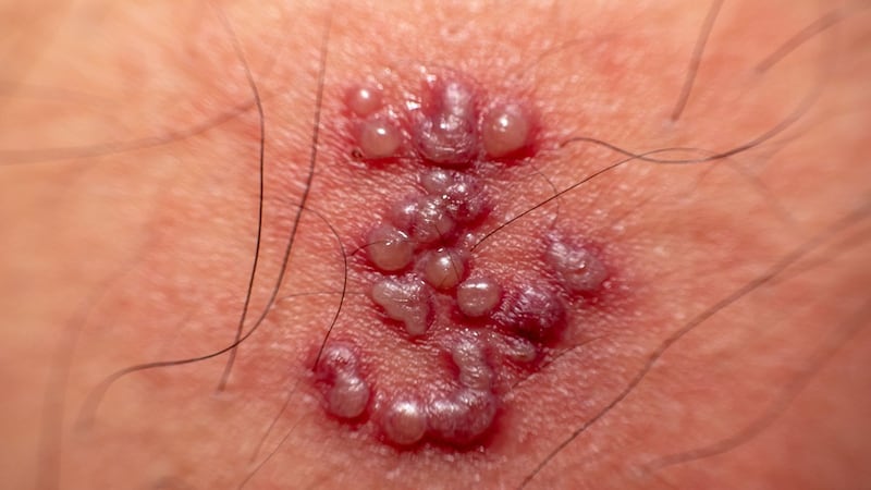 Ampollas herpes zóster